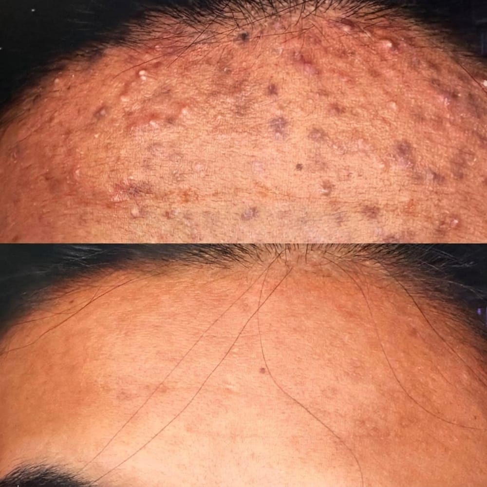 Before and after: forehead acne and bumps cleared to smooth skin