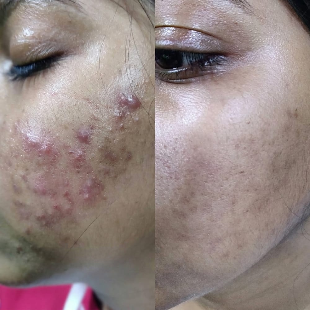 Before and after: active acne with dark marks on the cheek, cleared to even-toned skin