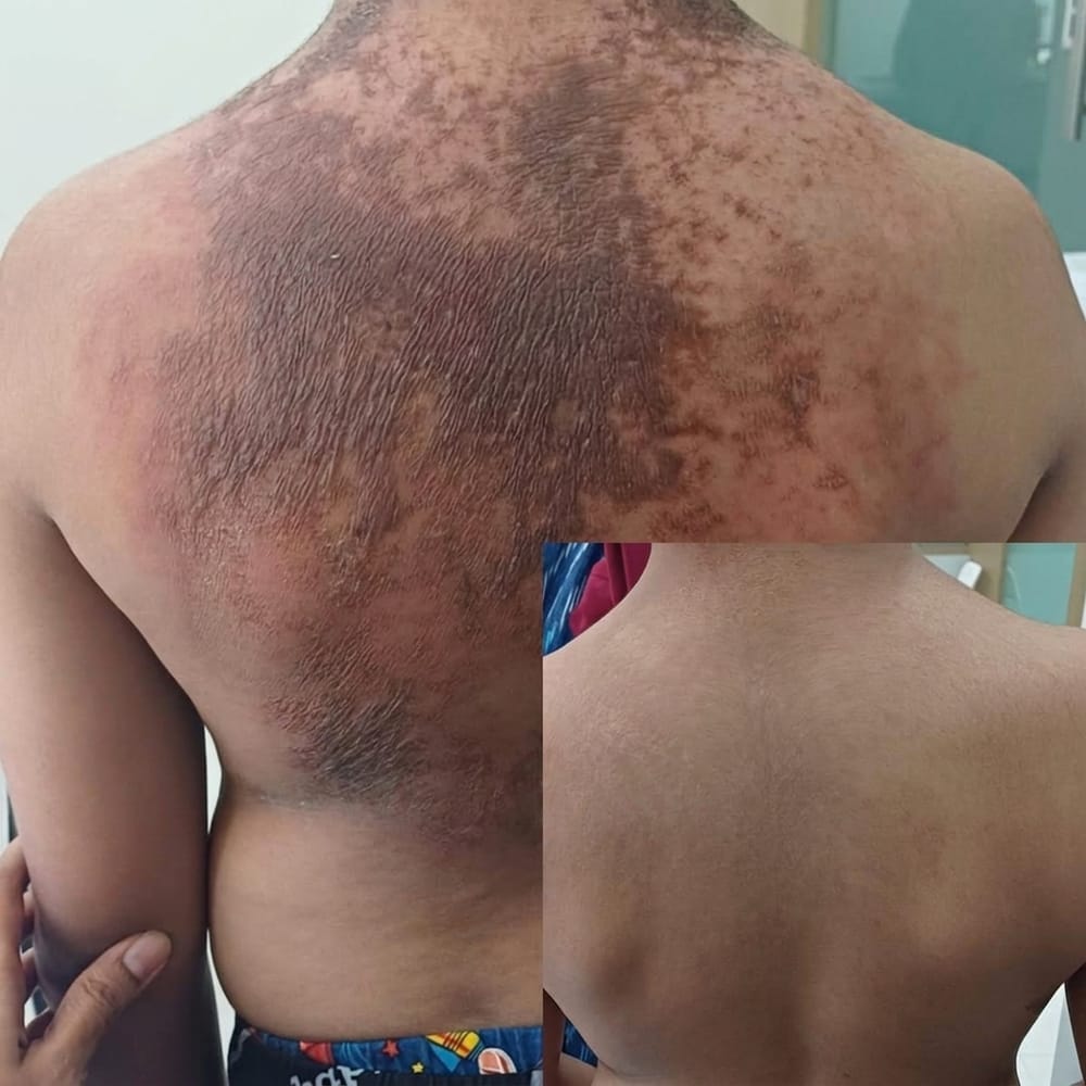 Before and after: extensive dark scaly skin condition on the back, fully settled to even tone