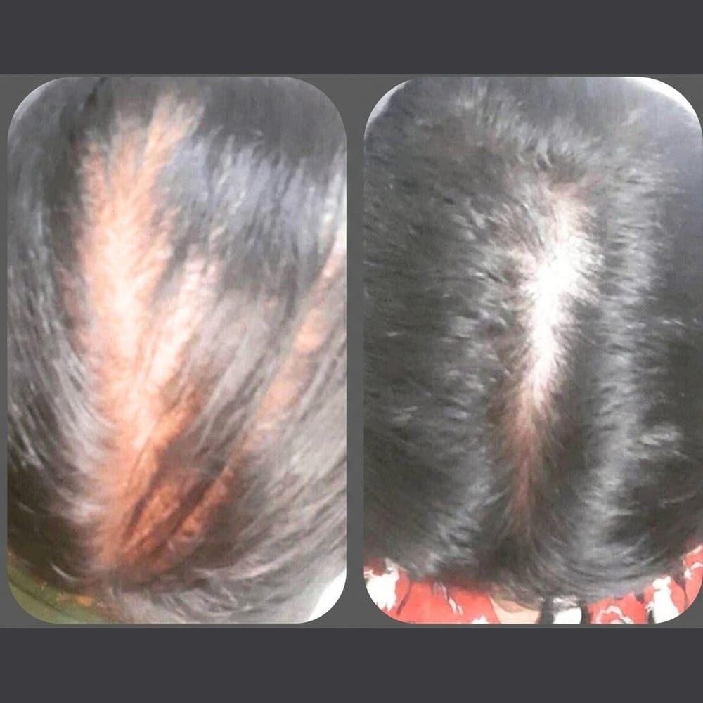 Before and after: visible scalp thinning restored to denser hair growth