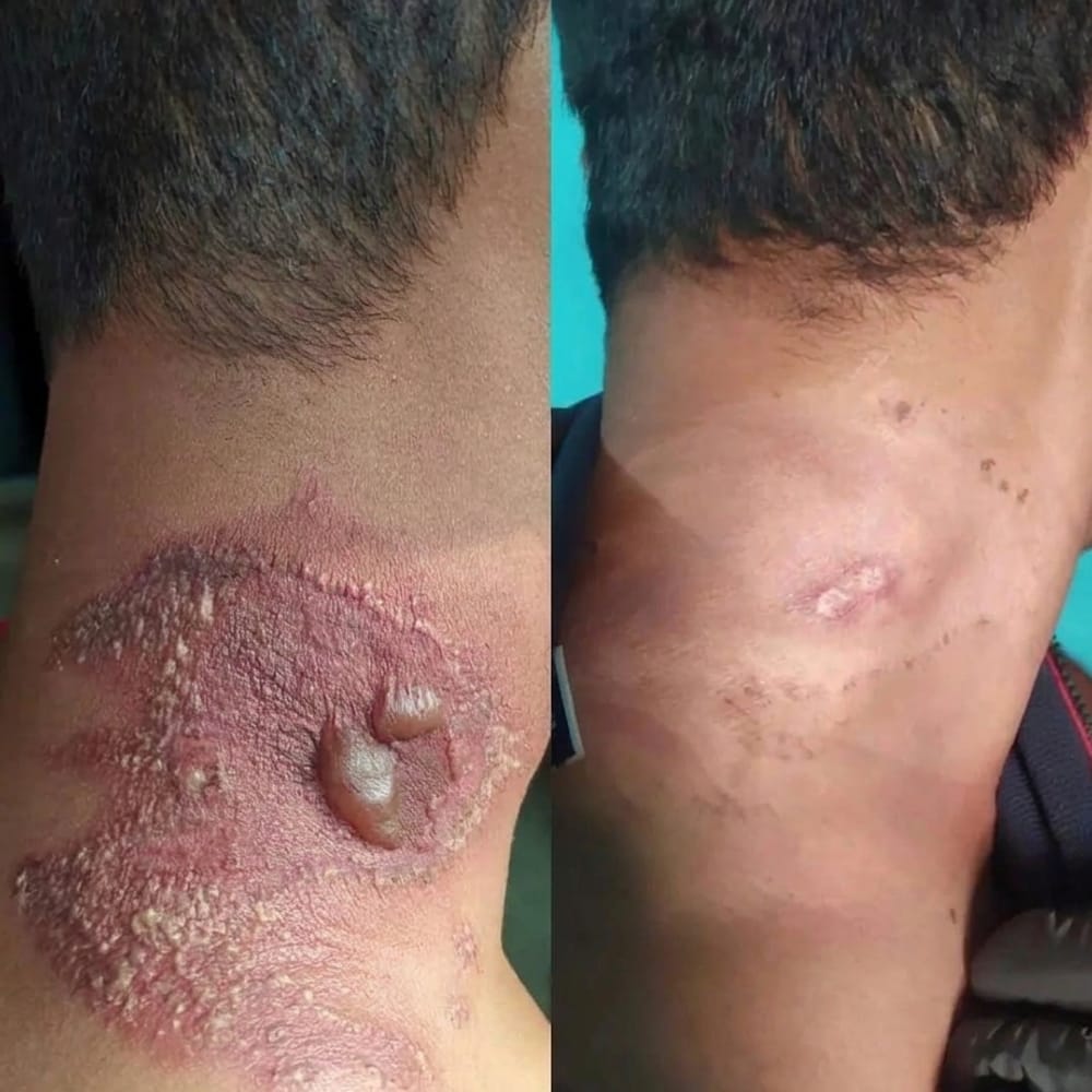 Before and after: raised inflamed lesion on the neck, calmed and flattened to smooth skin