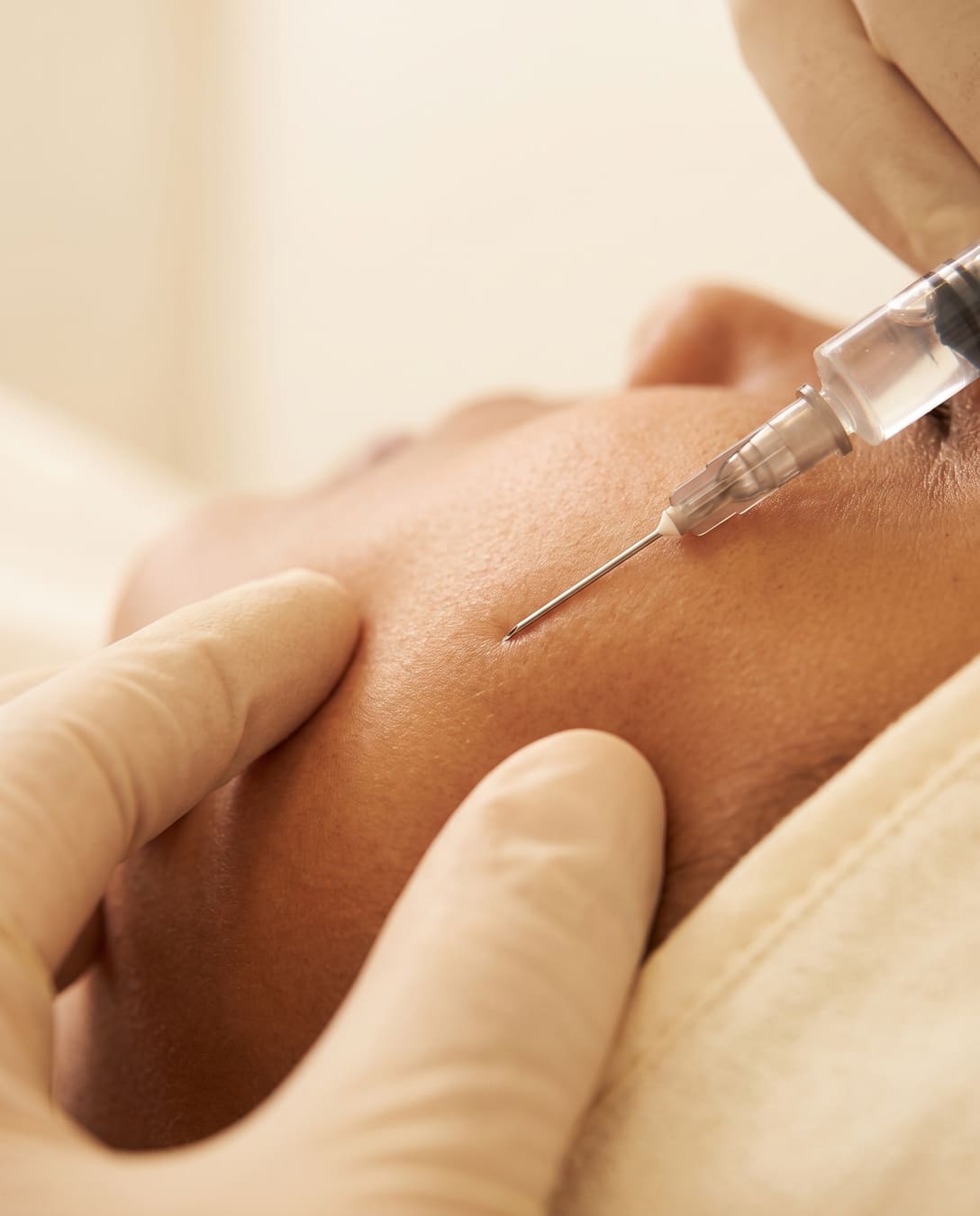 Fine syringe injecting dermal filler beneath the skin