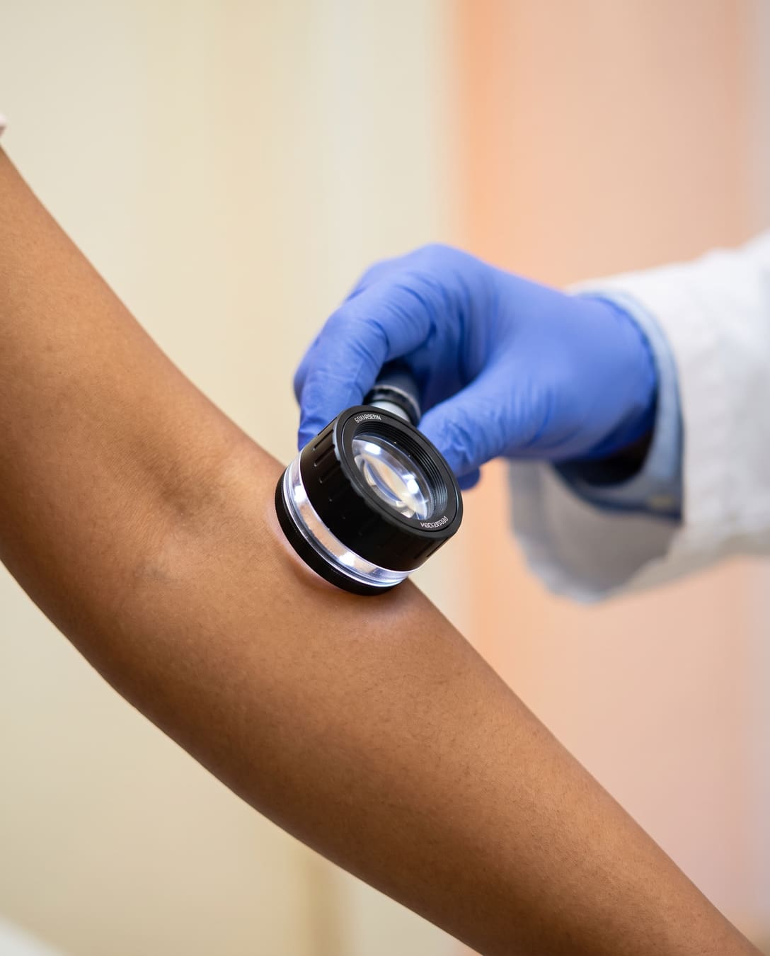 Dermatoscope examining Indian skin during a clinical diagnosis