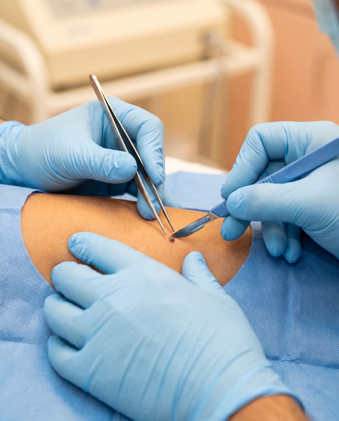 Gloved hands removing a small skin lesion with surgical instruments