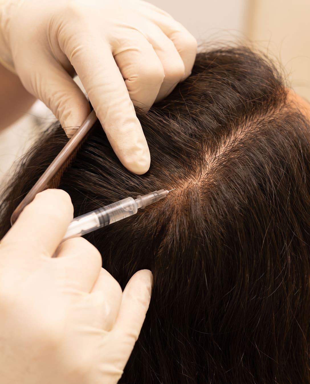 PRP injection into the scalp during a hair loss treatment