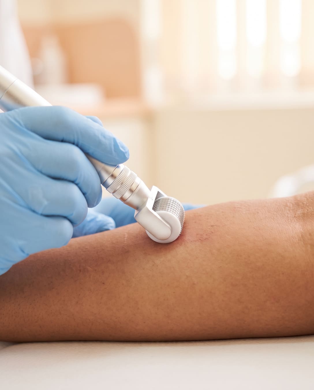 Microneedling dermaroller treating acne scars on the skin