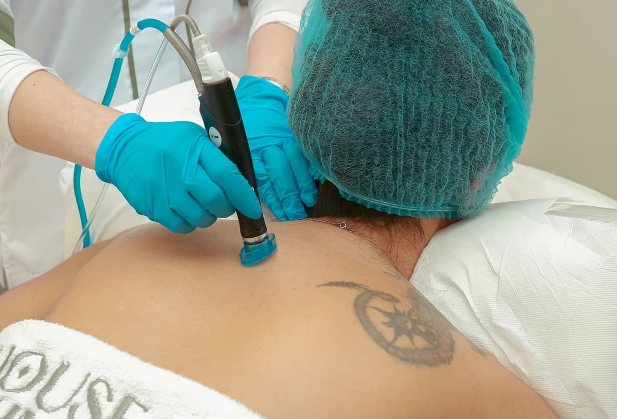 Professional laser removing a tattoo from the skin