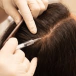 PRP injection into the scalp during a hair loss treatment