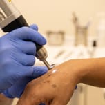 Laser handpiece treating dark pigmentation spots on the skin