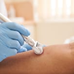 Microneedling dermaroller treating acne scars on the skin